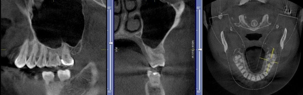 normal sinus floor | CAD-Ray.com