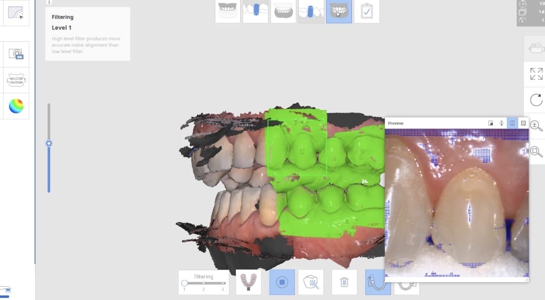 Video demonstratring how we capture the patient's left buccal bite in "Occlusion 1 Window