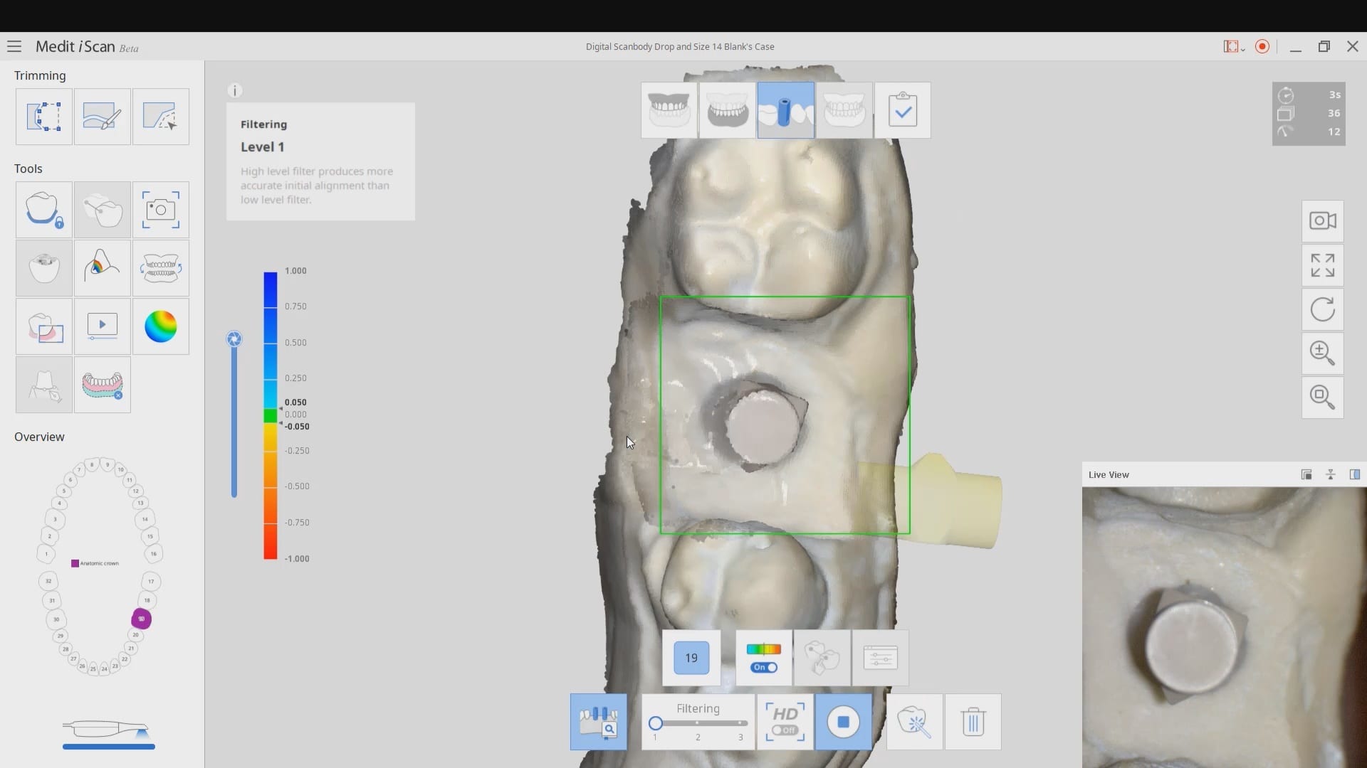 Medit's i500 Artifical Intelligence Identifies Implant Fixture