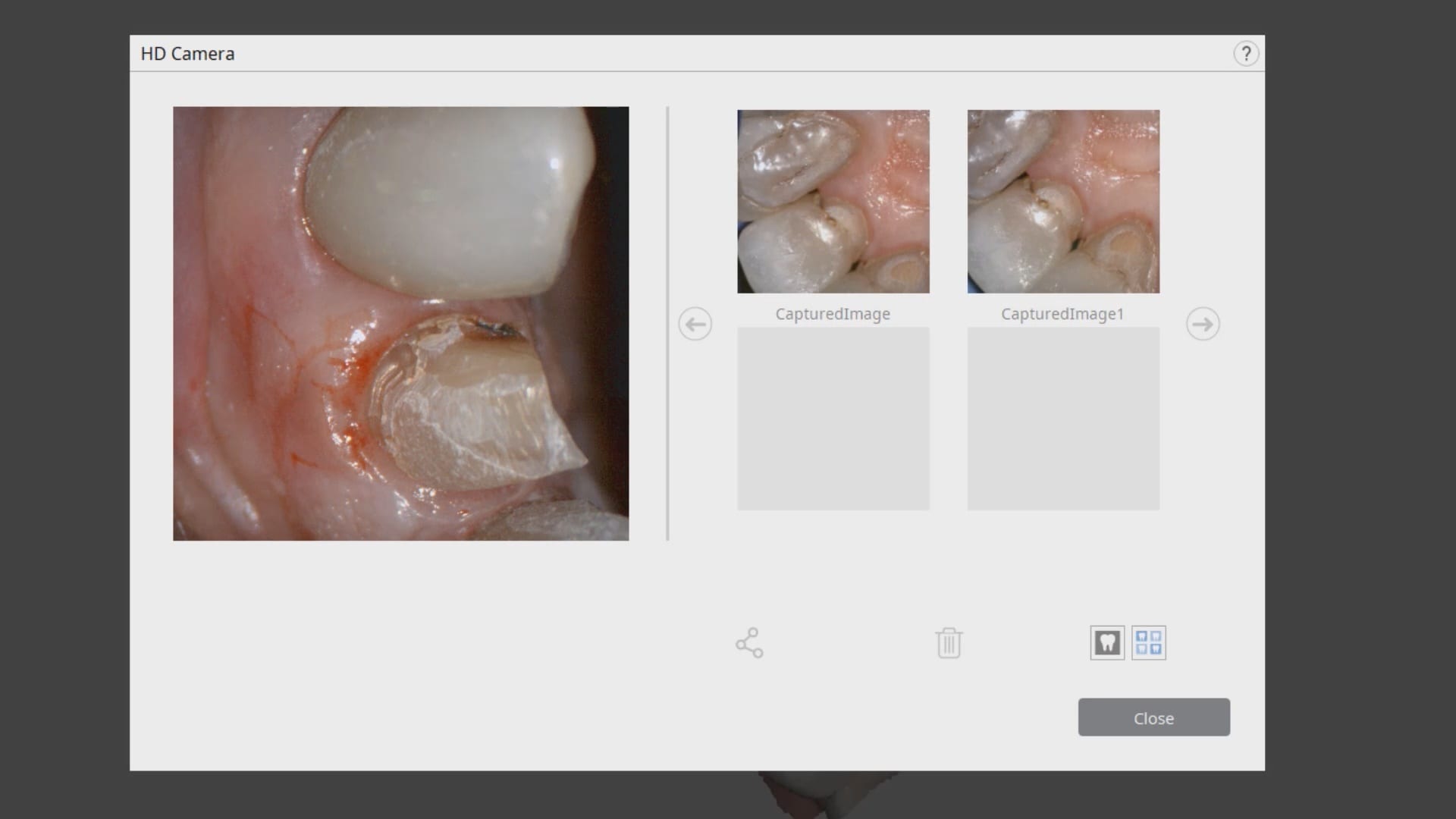 Crown Replacement Due To Recurrent Decay with Medit i500