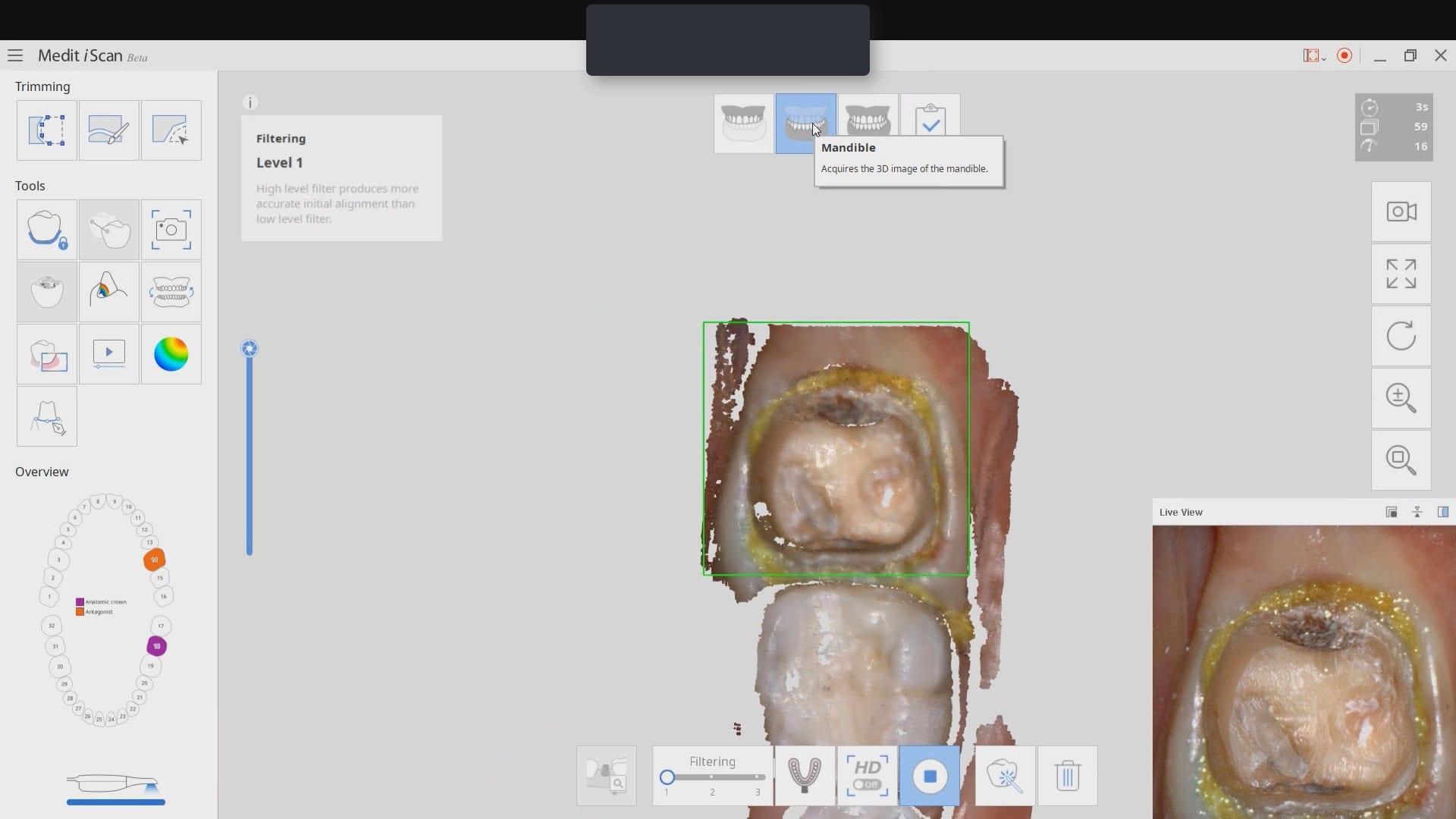 Image in Medit, Design in exocad, Mill with CEREC