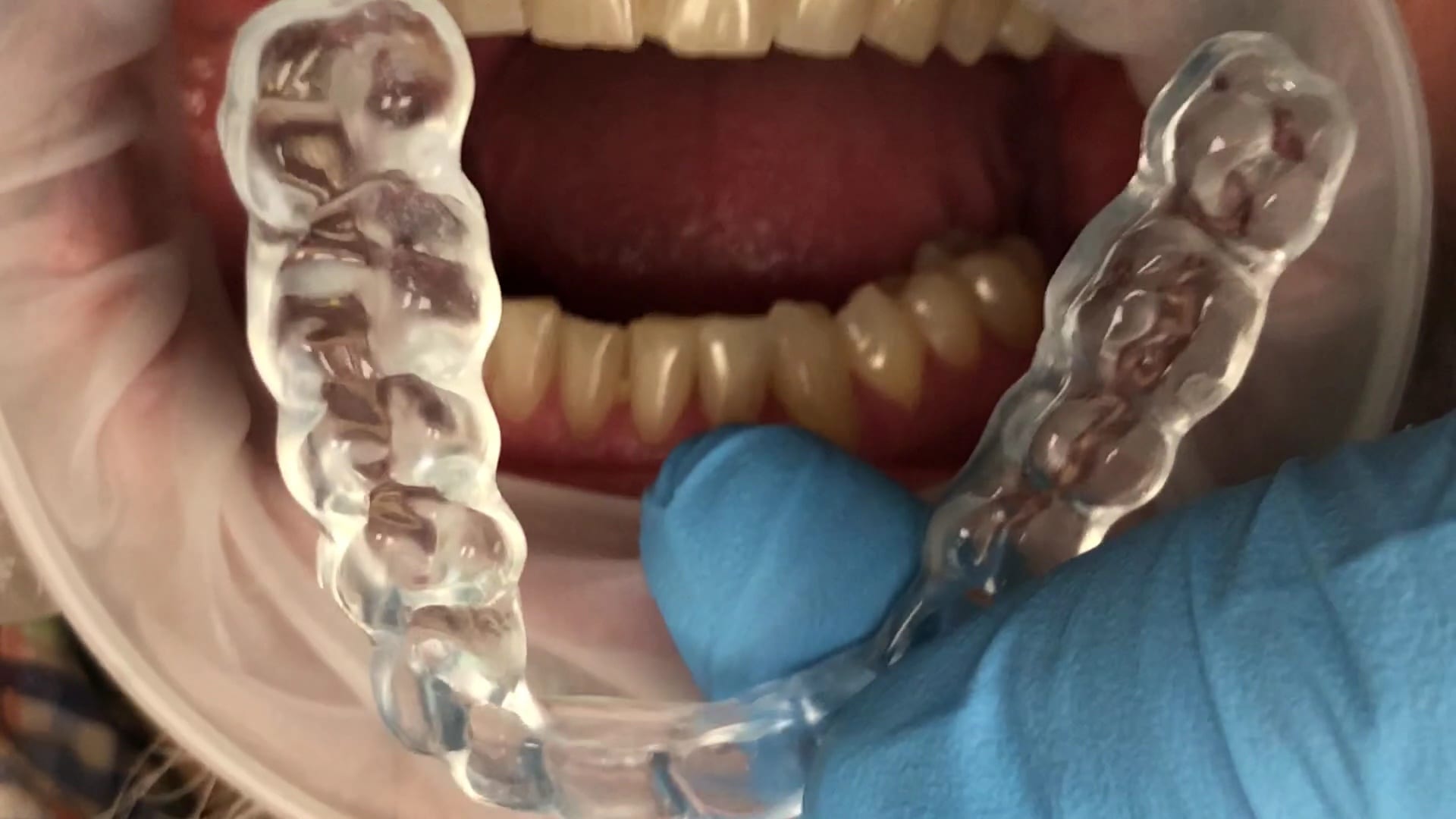 Digitally Desgined and Milled Occlusal Guard