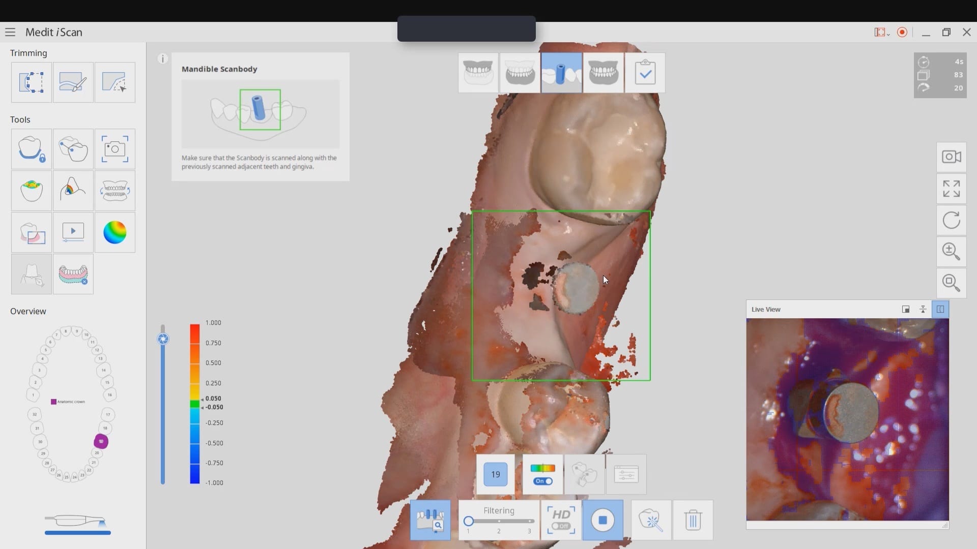 medit i500 artifical intelligence scanbody identification